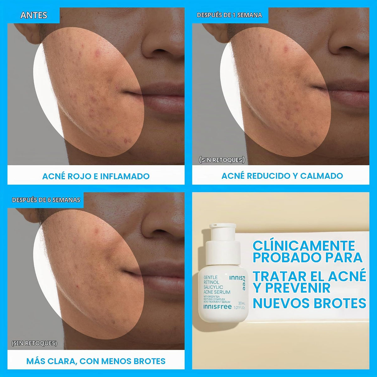 innisfree Suero para acné salicílico suave con retinol | Tratamient...