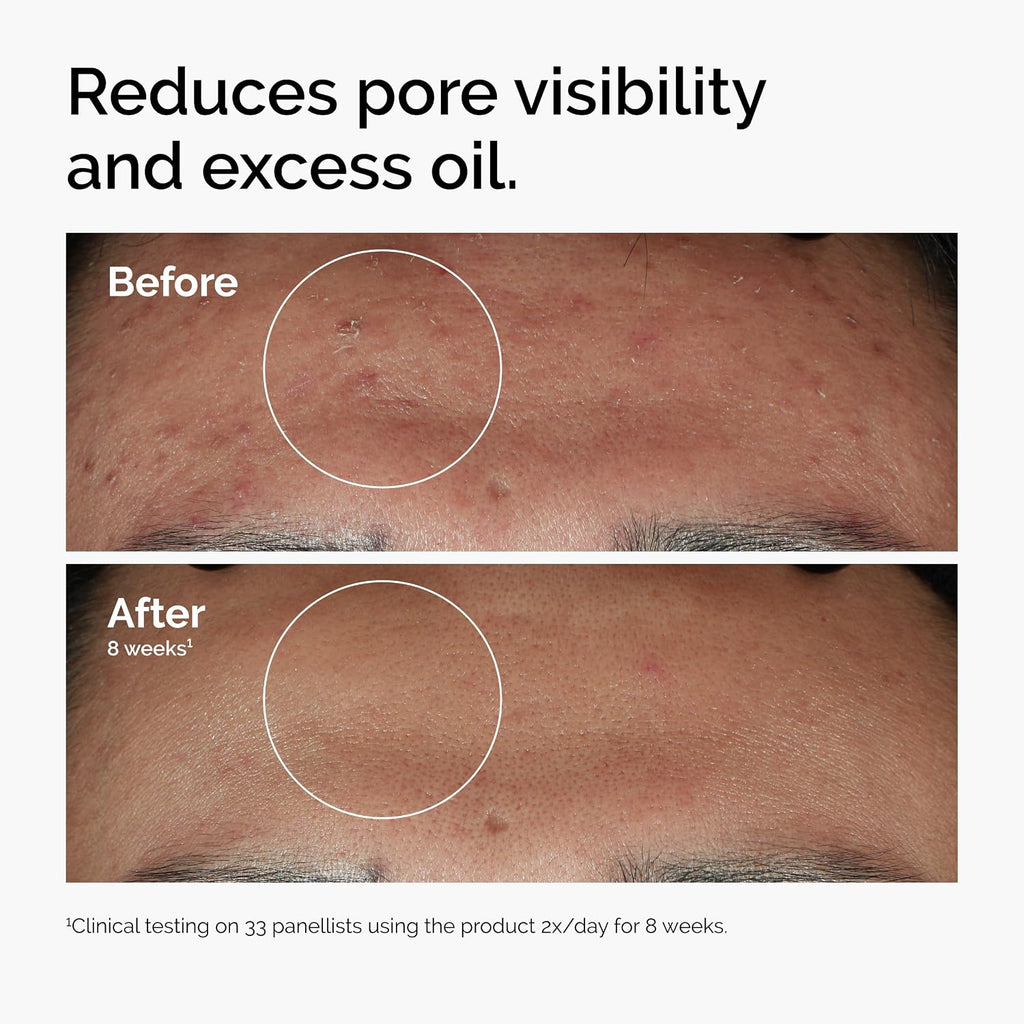 The Ordinary Niacinamida 10% + Zinc 1%, sérum suavizante para piele...