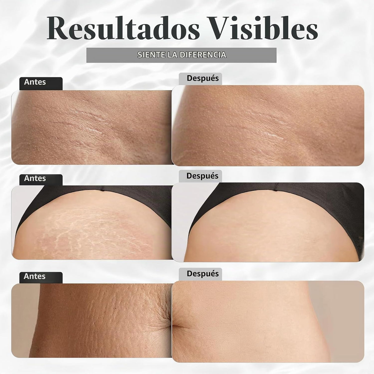 Crema para estrías \u2013 Hidrata la piel, apoya la elasticidad y c...