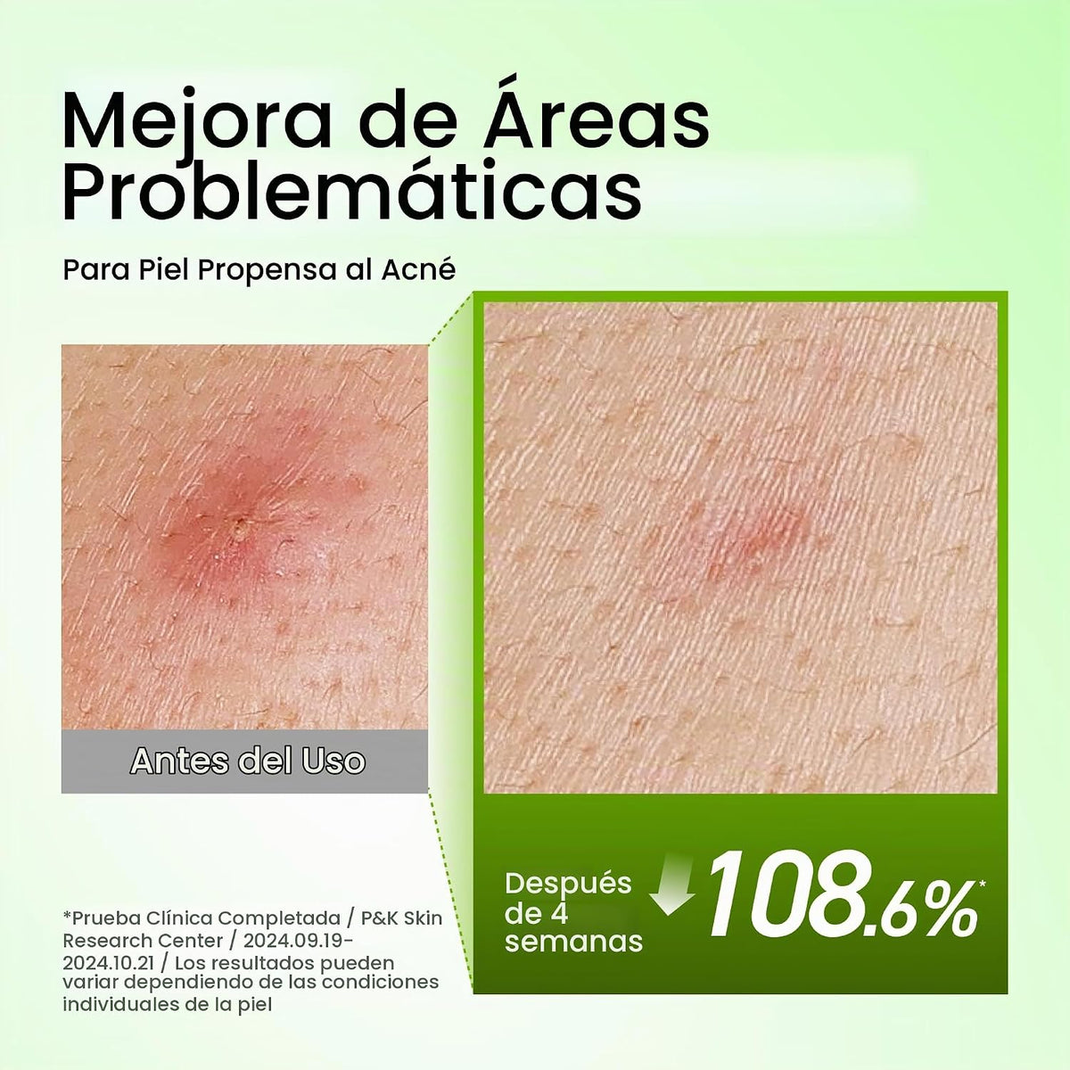 Anua Azelaic Acid 10 Hyaluron Suero calmante para el enrojecimiento...