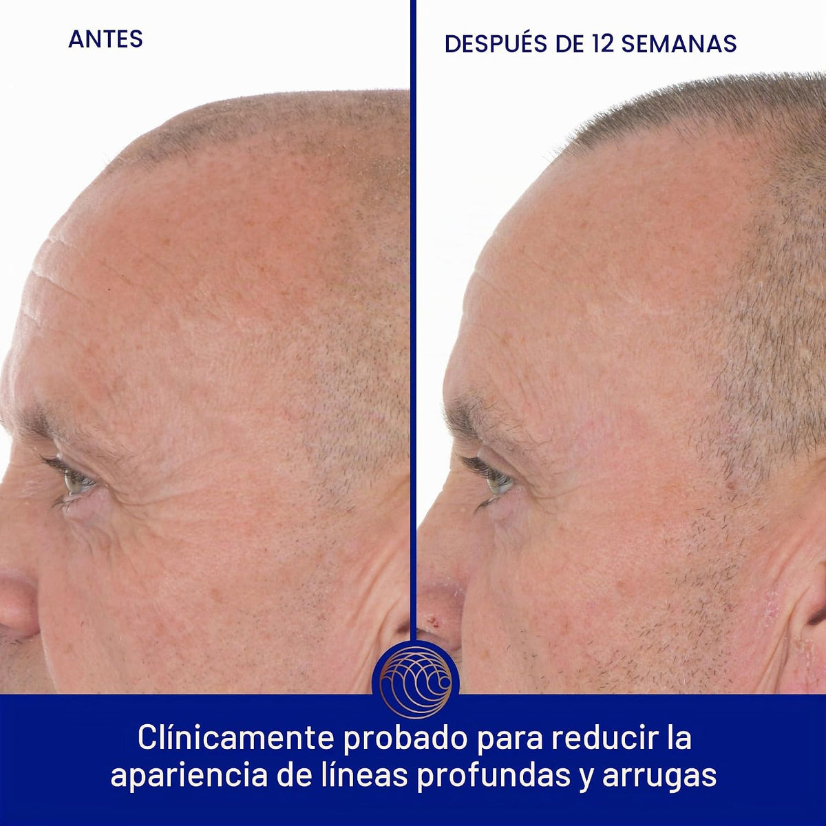 El suero de retinol