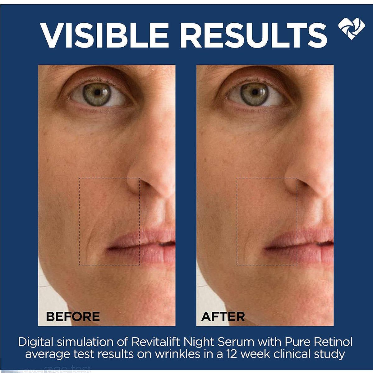 L'Oreal Paris Revitalift - Suero nocturno de retinol 0.3% puro,...