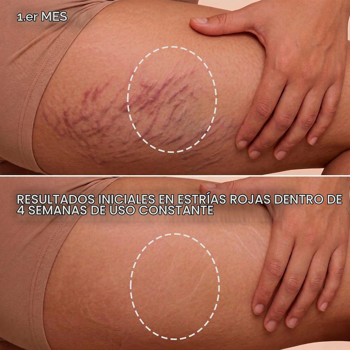 Cicatrissim Crema roja para estrías rojas y moradas, suaviza las es...