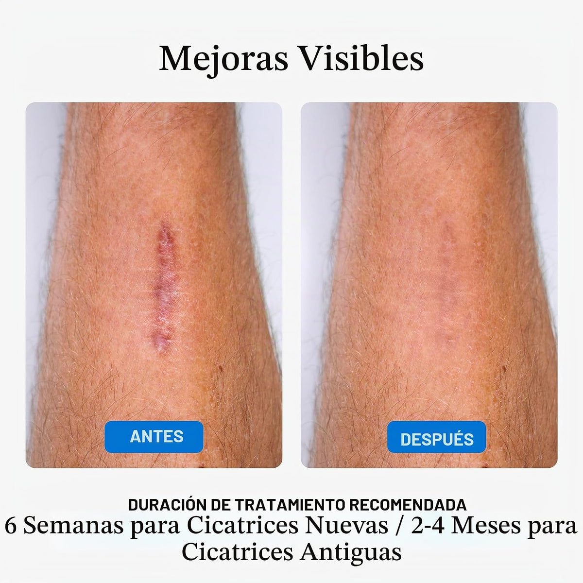 NUVADERMIS, láminas de silicona para cicatrices \u2013 láminas médi...