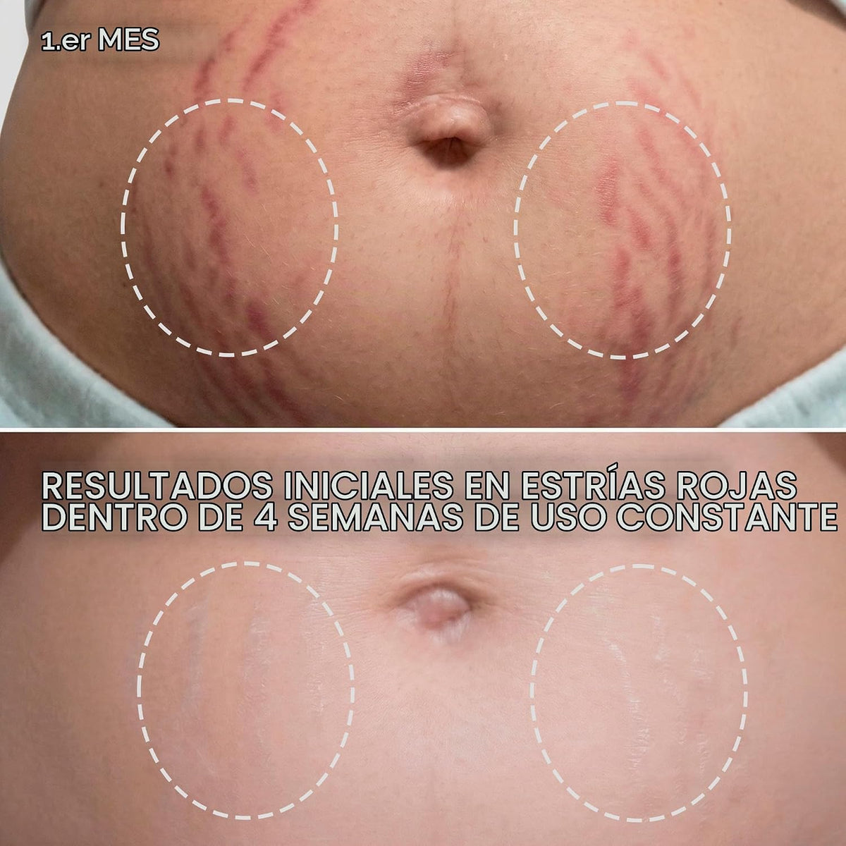 Cicatrissim Crema roja para estrías rojas y moradas, suaviza las es...