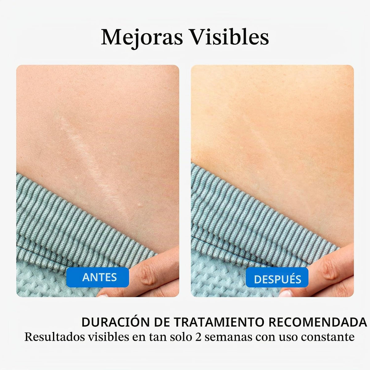 NUVADERMIS - Crema de gel de silicona para cicatrices quirúrgicas y...