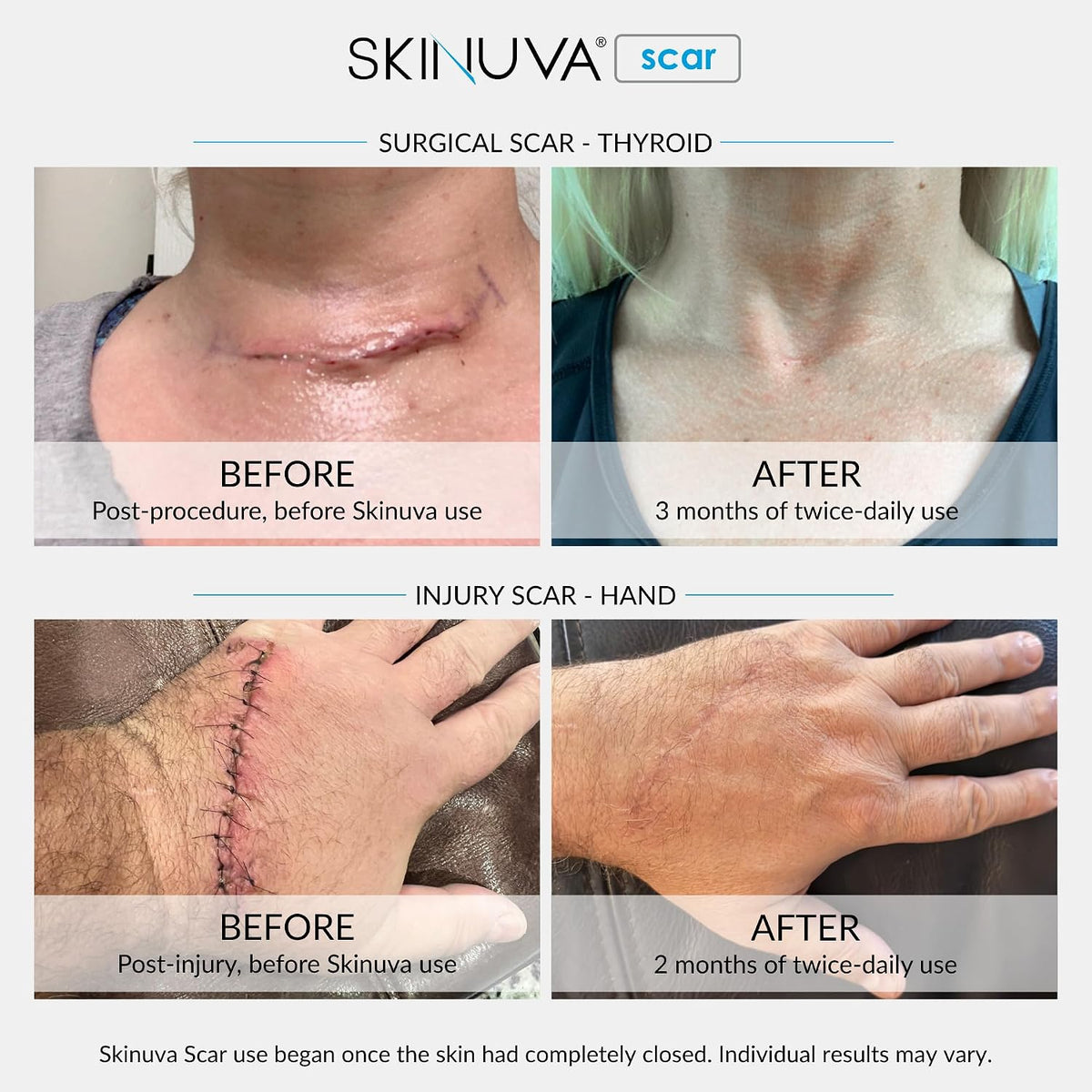 Skinuva® Crema para cicatrices para cara y cuerpo (1 oz) (paquete d...