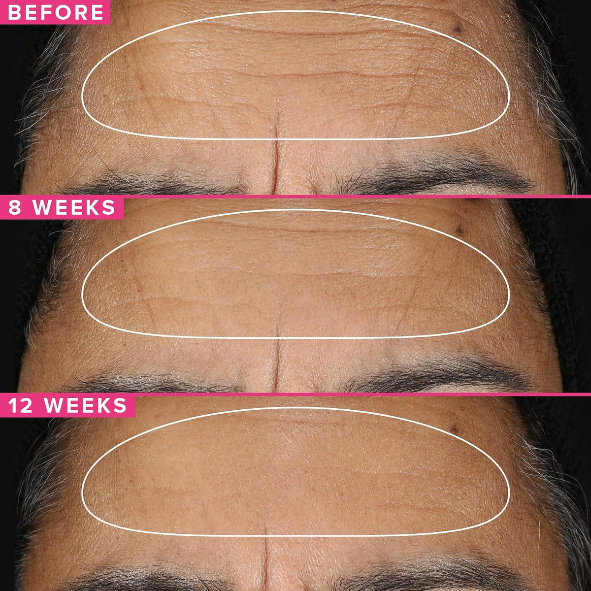 Farmacy Suero de retinol para la cara, 1% de vitamina A antienvejec...